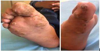 Plantar Warts in an Immunocompromised Child