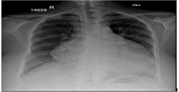 Fluid Filled Striae-Another Sign of Overload