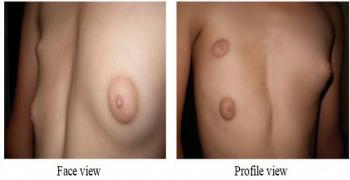 Supernumerary Breast in an Adolescent girl