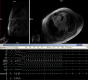 Cardiovascular Magnetic Resonance (CMR) in Electrophysiology