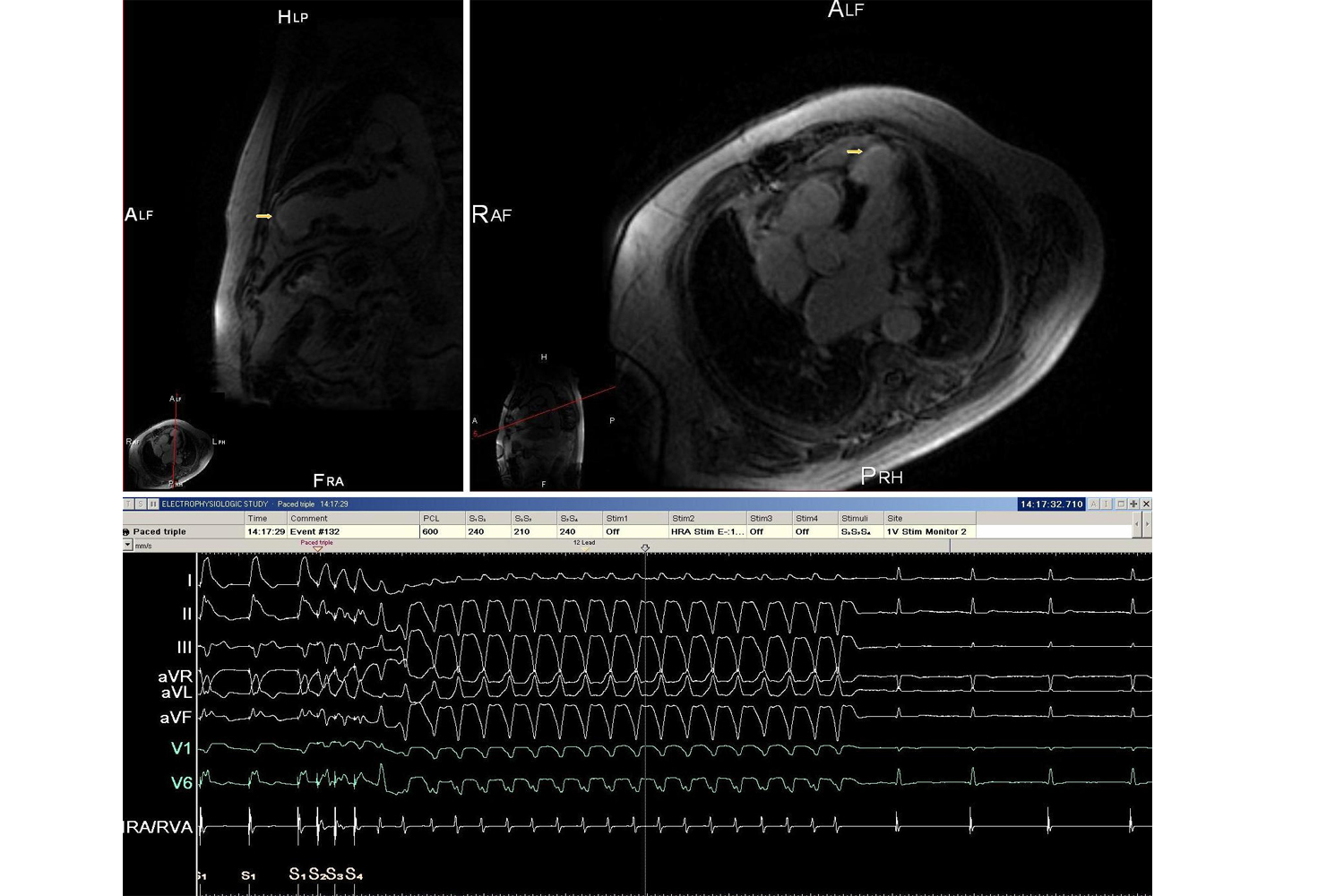 Cardiovascular Magnetic Resonance (CMR) in Electrophysiology