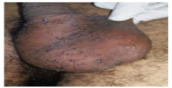 Chronic Bleeding of the Scrotal Skin: What Could It Be?