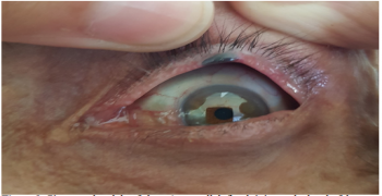 Basal Cell Carcinoma of the Upper Palpebral Mucosa Simulating a Dermoscopically Melanoma