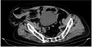 Incarcerated Spiegel Hernia