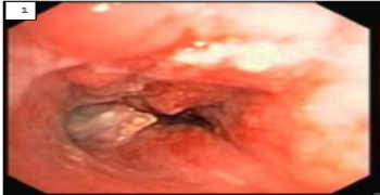 Delayed Presentation of Foreign Body Aspiration in an Adult