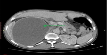 Giant Hydronephosis of the Upper System on Pyelo-ureteral Duplicity