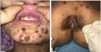 Malignant Chickenpox Complicated by Silent Pneumonia