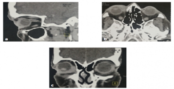 An Atypical Case of Epithelial-myoepithelial Carcinoma of the Lacrymal Gland