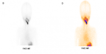 Accuracy of SPECT-CT Imaging in the Diagnosis of a Dual Ectopic Thyroid: A Case Report