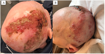 Zosteriform Cutaneous Metastases of Unknown Primary Melanoma