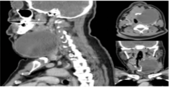 A Cystic Cervical Mass in an Adult Patient