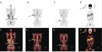 18F-FDG PET/CT Findings in Neurofibromatosis Type 3