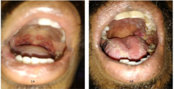 Multiple Painful Oral Apthous Ulcers in Crohns Disease