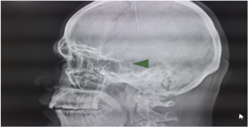 Skull X-Ray Lateral View Used as a Screening Tool in Suspected Case of Pituitary Macro Adenoma