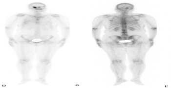 Single Orbital Bone Metastasis of Infiltrative Breast Carcinoma in Adults: Interest of a 3-Fields of View Bone SPECT-CT Acquisition