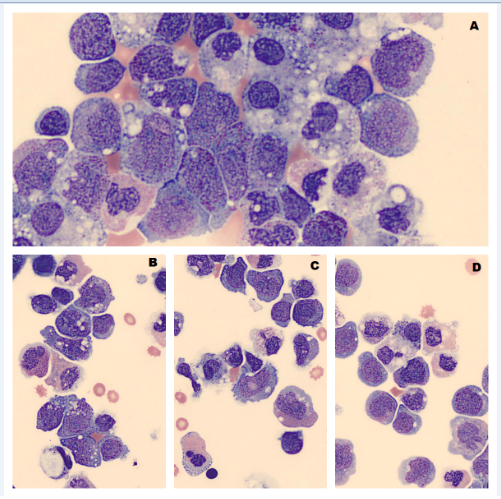 Myeloblasts in Pleural Effusion