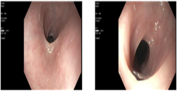 Esophageal Webs in a 59-Year-Old Female