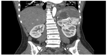 Splenic infarct secondary to septic embolus: an infective endocarditis spectrum