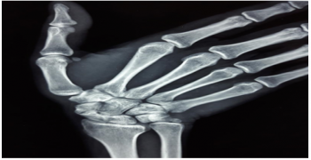 Scaphoid Non-Union 