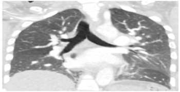 Pulmonary Fibrosis in COVID-19