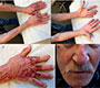 Rash on Sun Exposed Areas of Skin