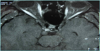 Mesiotemporal Epilepsy and Ophtalmoplegia Revealing an Unusual Cavernoma Location