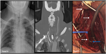 Inadvertent Arterial Placement of Companion Central Venous Line Placement: Seldingers Technique Revisited