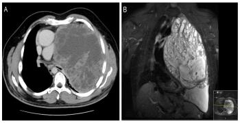 Primary Sarcoma of the Lung: A Very Rare Diagnosis