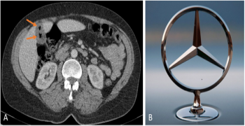 The Mercedes Benz Sign: An Indicator of Gallstones