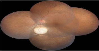 Rare Presentation of Unilateral Chorio-Retinal Coloboma in a Patient with Bilateral Retinitis Pigmentosa