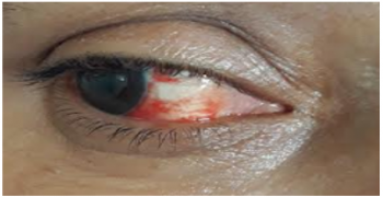Tears and Pink Eye: An Unusual Presentation of COVID-19
