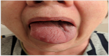 Unilateral Angioedema