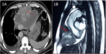 Primary Pericardial Sarcoma: A Rare Cause of Acute Heart Failure