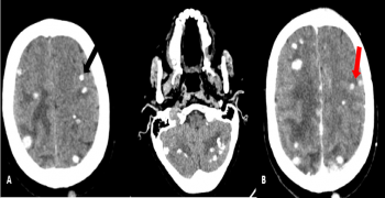 Multiple Intracranial Calcifications: Think About Miliary Brain Metastases!