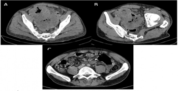 Small Bowell Lymphoma: Aneurysmal Pattern