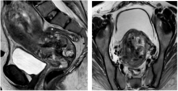 Unusual Cause of Post-Menopausal Metrorrhagia: Uterine Choriocarcinoma