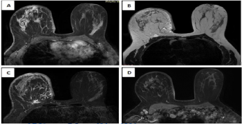 Prepectoral Edema: A Specific MRI Finding of Breast Cancer