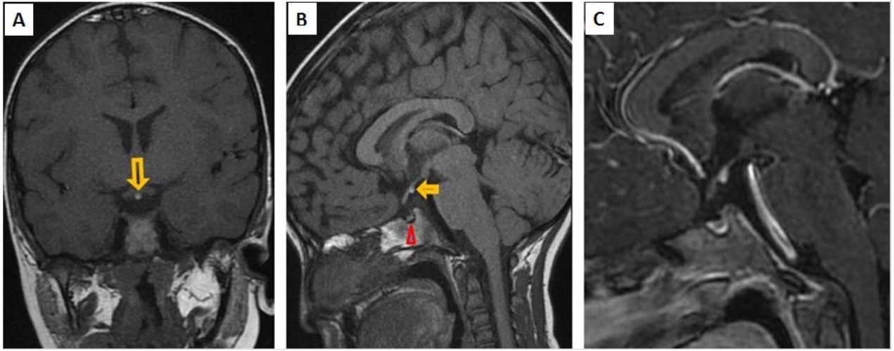 Pituitary Stalk Interruption Syndrome (PSIS): Specific MRI Findings
