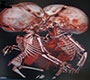 Imaging of Thoraco-Omphalopagus Conjoined Twins in the Interventional Radiology Suite