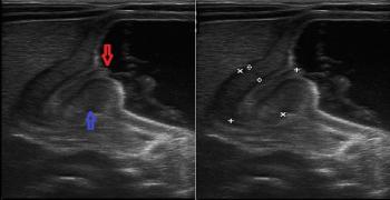 Cervix and Antral Nipple Signs: Sonographic Appearances of Pyloric Stenosis