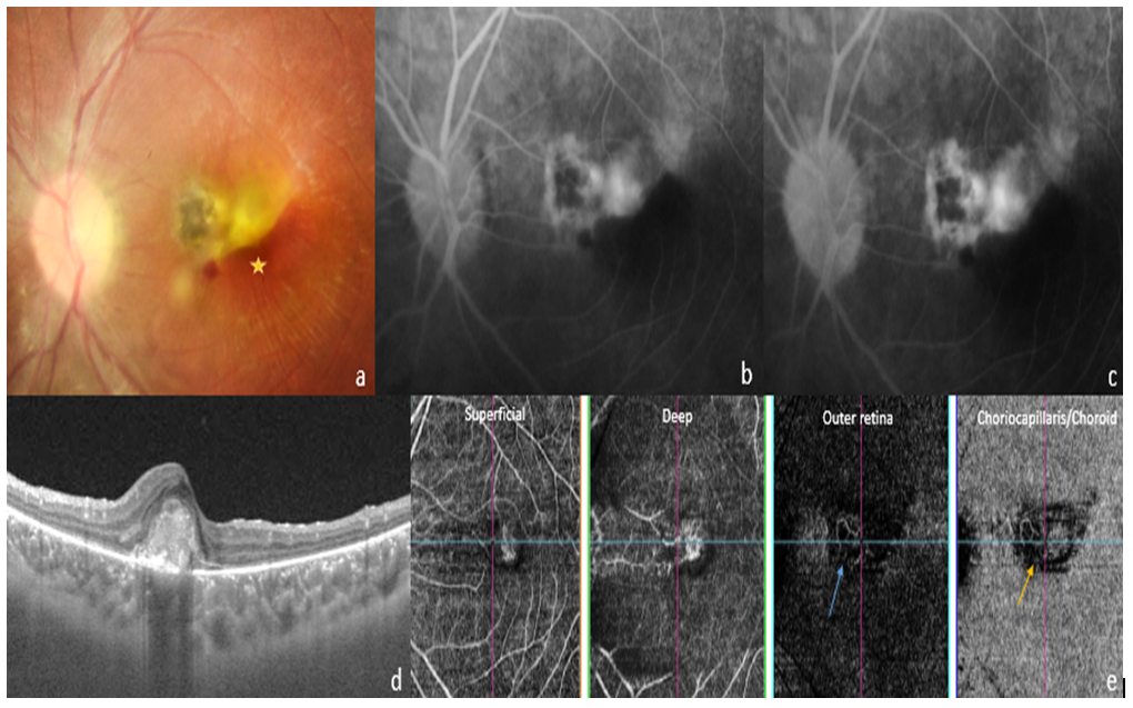 Multimodal Imaging in Ocular Toxoplasmosis Complicated By Choroidal Neovascularizationd