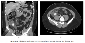 A Case of a Giant Appendicolith