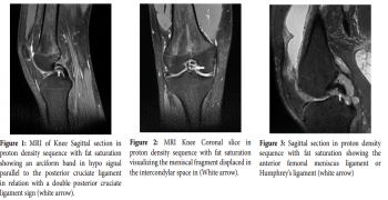 Double Posterior Cruciate Ligament: Signs in Bucket-Handle Tear in the Medial Meniscus