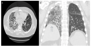 Unilateral Pulmonary Fibrosis due to Acute Amiodarone Toxicity