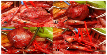 Scarcely Seen Carotid Body Tumor Feeding by both External and Internal Carotid System