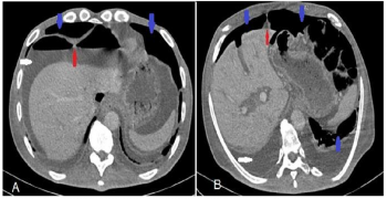 Silver Sign or Falciform Ligament Sign in Pneumoperitoneum