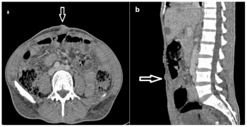 Sister Mary Joseph Nodule Case Study