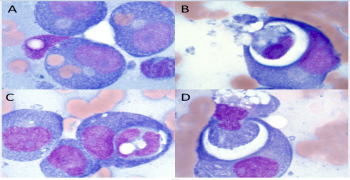 Hemophagocytosis in Acute Myeloid Leukemia