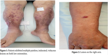 A Cutaneous Relapsing of a Diffuse Large B Cell Lymphoma on Schedule Appointment