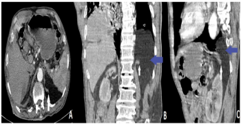 Asymptomatic Bochdalek's Hernia in Adults